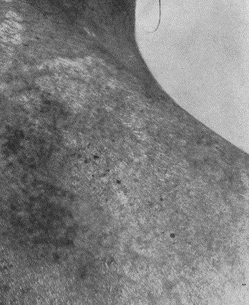 Застарелые поражения правой лопаточной области