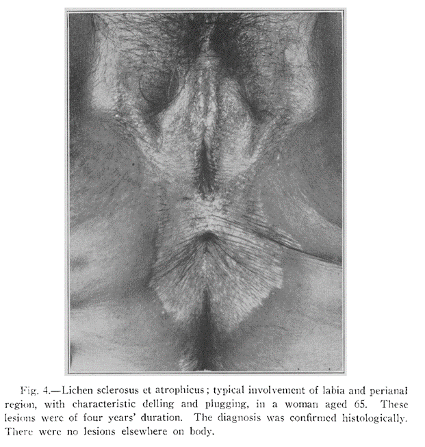 Классическое поражение в виде цифры 8