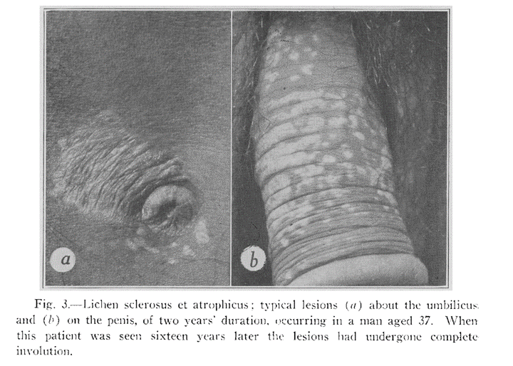 Белые конфети-подобные папулы на половом члене