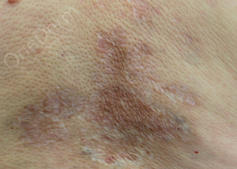 Папулы плотные, белого цвета, опалесцирующие, похожи на конфетти, группируются в бляшки