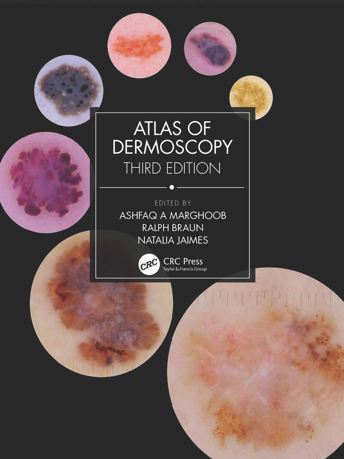 Atlas of Dermoscopy