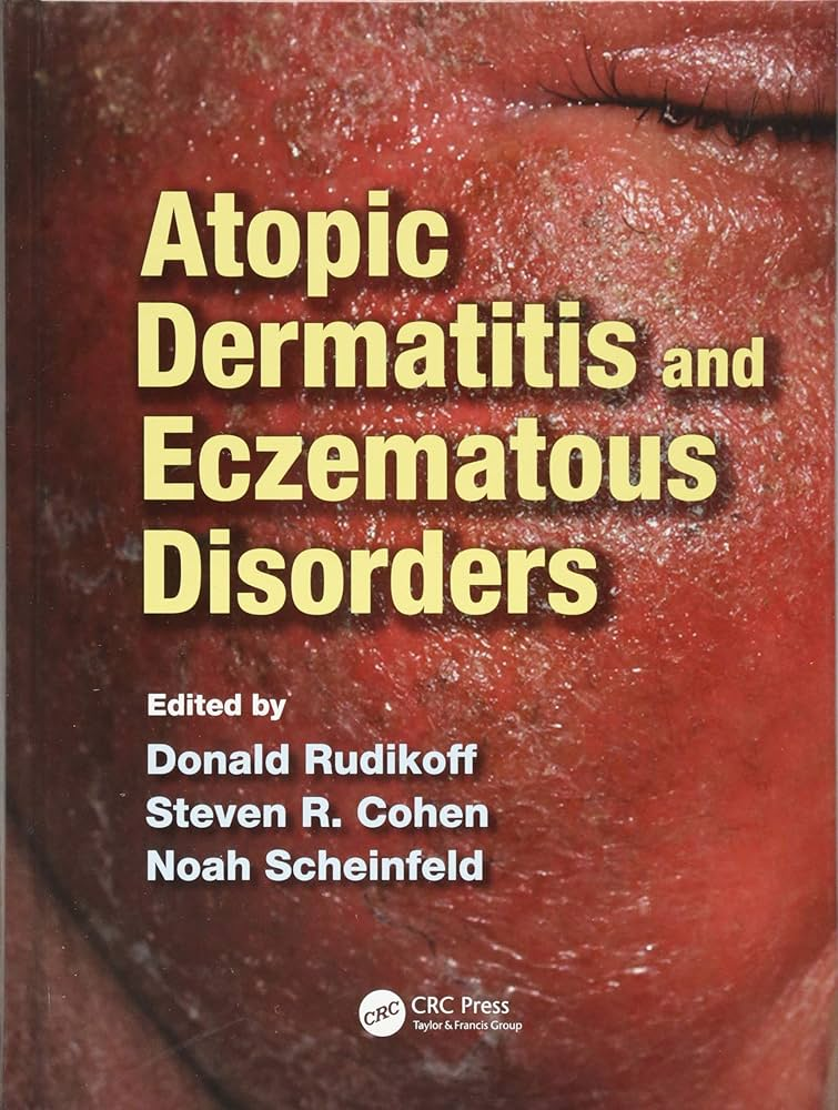 Atopic Dermatitis and Eczematous Disorders. D. Rudikoff