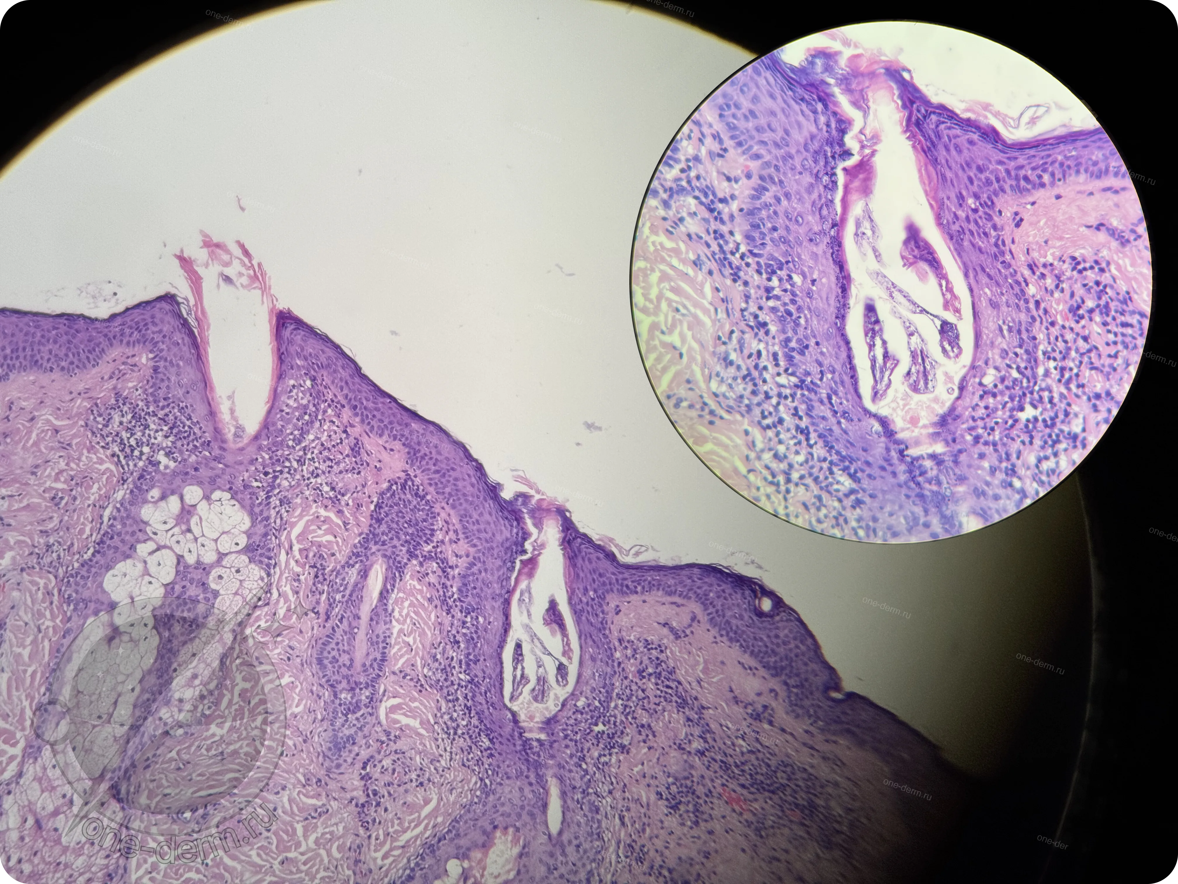 Demodex в просвете волосяного фолликула