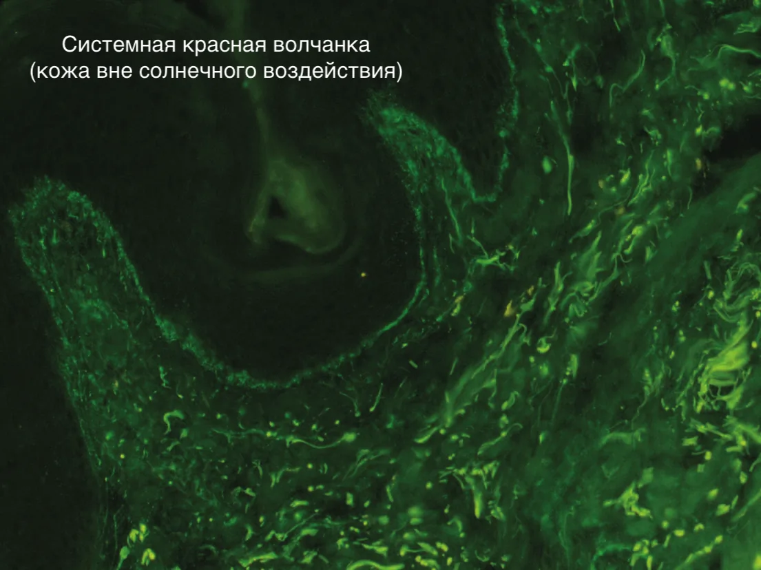 Положительный тест: отложения IgM по дермо-эпидермальному соединению в клинически интактной коже, защищённой от солнечного облучения, у 26-летней женщины с системной красной волчанкой